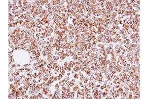 IHC-P Image Immunohistochemical analysis of paraffin-embedded human gastric cancer, using OAT, antibody at 1:100 dilution. (OAT 抗体)