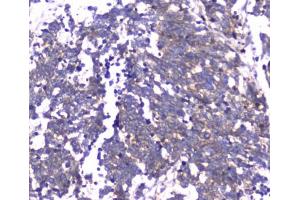 IHC testing of FFPE human lung cancer tissue with RAB27A antibody at 1ug/ml.