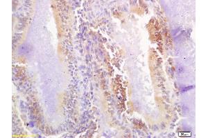 Formalin-fixed and paraffin embedded human breast carcinoma labeled with Rabbit Anti Phospho-BAP1(Ser592) Polyclonal Antibody, Unconjugated (ABIN683413) at 1:200 followed by conjugation to the secondary antibody and DAB staining (BAP1 抗体  (pSer592))
