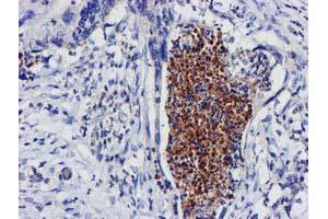 Immunohistochemical staining of paraffin-embedded Carcinoma of Human pancreas tissue using anti-EXOSC7 mouse monoclonal antibody. (EXOSC7 抗体)