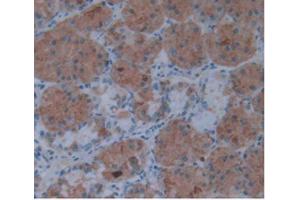 IHC-P analysis of Human Stomach Cancer Tissue, with DAB staining. (IL1A 抗体  (AA 113-271))