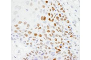 Immunohistochemistry (IHC) image for anti-Tumor Protein P53 (TP53) (AA 50-100) antibody (ABIN7448707)