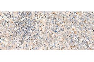 Immunohistochemistry of paraffin-embedded Human cervical cancer tissue using GALR1 Polyclonal Antibody at dilution of 1:60(x200) (Galanin Receptor 1 抗体)