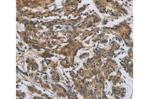 Immunohistochemistry of Human colon cancer using SYN1 Polyclonal Antibody at dilution of 1:50 (SYN1 抗体)