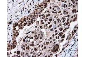Immunohistochemical staining of paraffin-embedded Adenocarcinoma of breast tissue using anti-KIAA1609 mouse monoclonal antibody. (KIAA1609 抗体)