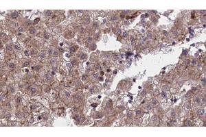ABIN6273972 at 1/100 staining Human liver cancer tissue by IHC-P. (OR1L1 抗体)