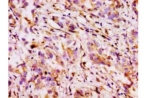 Immunohistochemistry of paraffin-embedded human liver cancer using ABIN7160310 at dilution of 1:100