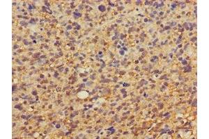Immunohistochemistry of paraffin-embedded human glioma using ABIN7149878 at dilution of 1:100 (DKK1 抗体  (AA 33-266))