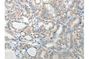 The image on the left is immunohistochemistry of paraffin-embedded Human thyroid cancer tissue using ABIN7189711(AGAP1 Antibody) at dilution 1/25, on the right is treated with synthetic peptide. (AGAP1 抗体)