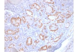 Formalin-fixed, paraffin-embedded human Lung Adenocarcinoma stained with TTF-1 Mouse Recombinant Monoclonal Antibody (rNX2. (Recombinant NKX2-1 抗体)