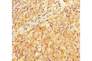 Immunohistochemistry of paraffin-embedded human lung cancer using ABIN7172403 at dilution of 1:100 (SMARCA4 抗体  (AA 808-1092))