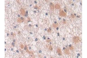 Detection of TGFb3 in Human Glioma Tissue using Polyclonal Antibody to Transforming Growth Factor Beta 3 (TGFb3) (TGFB3 抗体  (AA 24-300))
