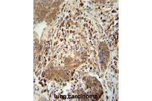 TAGAP antibody (Center) immunohistochemistry analysis in formalin fixed and paraffin embedded human lung carcinoma followed by peroxidase conjugation of the secondary antibody and DAB staining.