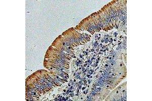 Immunohistochemical analysis of PHACS staining in human colon cancer formalin fixed paraffin embedded tissue section. (PHACS 抗体)