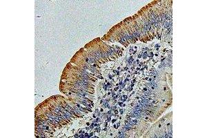 Immunohistochemical analysis of PHACS staining in human colon cancer formalin fixed paraffin embedded tissue section.