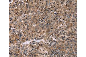 Immunohistochemistry of Human colon cancer using FAM107A Polyclonal Antibody at dilution of 1:30 (FAM107A 抗体)