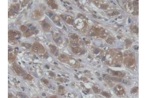 DAB staining on IHC-P; Samples: Human Breast cancer Tissue (CRABP1 抗体  (AA 2-137))
