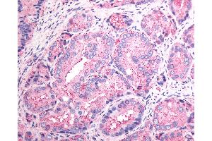 Anti-SSTR1 antibody IHC of human Prostate, Carcinoma. (SSTR1 抗体  (N-Term))