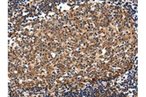 The image on the left is immunohistochemistry of paraffin-embedded Human colorectal cancer tissue using ABIN7193115(ZNF473 Antibody) at dilution 1/30, on the right is treated with synthetic peptide. (ZNF473 抗体)