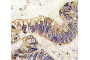 IHC analysis of FFPE human colon carcinoma tissue stained with SRC-1 antibody (NCOA1 抗体  (AA 1338-1367))