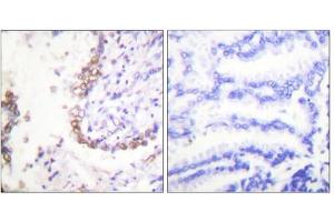 Immunohistochemical analysis of paraffin-embedded human lung carcinoma tissue, using OCT3 antibody (ABIN5976473). (OCT4 抗体  (Internal Region))