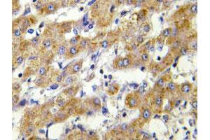 Immunohistochemical analysis of paraffin-embedded human liver carcinoma tissue using CYP2C8/CYP2C9/CYP2C18/CYP2C19 polyclonal antibody . (CYP2C8 抗体)