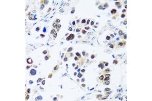 Immunohistochemistry of paraffin-embedded human lung cancer using BRIX1 antibody (ABIN7265951) at dilution of 1:100 (40x lens). (BRIX1 抗体  (AA 1-353))