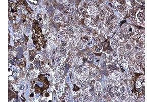 IHC-P Image MMP10 antibody detects MMP10 protein at secreted on human cervical carcinoma by immunohistochemical analysis. (MMP10 抗体)