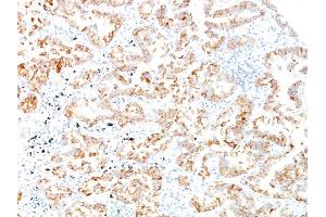 Formalin-fixed, paraffin-embedded human Lung SCC stained with Cytokeratin 7 Monoclonal Antibody (SPM270).