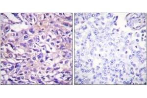 Immunohistochemistry analysis of paraffin-embedded human breast carcinoma, using MYPT1 (Phospho-Thr696) Antibody. (PPP1R12A 抗体  (pThr696))