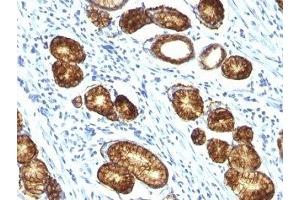 Formalin-fixed, paraffin-embedded human gastric carcinoma stained with Mucin-6 antibody (MUC6/916). (MUC6 抗体)