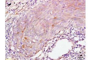 Formalin-fixed and paraffin embedded human lung carcinoma tissue labeled with Anti-S100A7 Polyclonal Antibody, Unconjugated (ABIN718301) at 1:200 followed by conjugation to the secondary antibody and DAB staining (S100A7A 抗体  (AA 41-108))