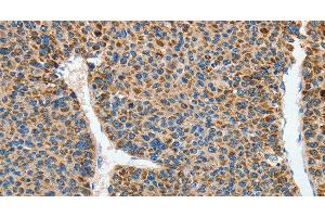 Immunohistochemistry of paraffin-embedded Human liver cancer using DSCR1 Polyclonal Antibody at dilution of 1:45 (RCAN1 抗体)