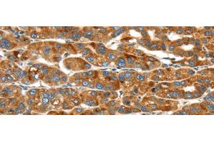 Immunohistochemistry of paraffin-embedded Human liver cancer using ERP44 Polyclonal Antibody at dilution of 1/20 (ERP44 抗体)