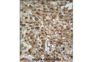 WDR43 Antibody immunohistochemistry analysis in formalin fixed and paraffin embedded human Cervix carcinoma followed by peroxidase conjugation of the secondary antibody and DAB staining.