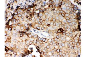 Anti- STIM1 Picoband antibody, IHC(P) IHC(P): Human Mammary Cancer Tissue (STIM1 抗体  (N-Term))