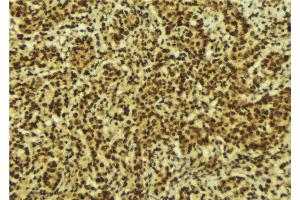 ABIN6269307 at 1/100 staining Human breast cancer tissue by IHC-P.