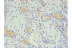 Immunohistochemical of paraffin-embedded Human breast cancer using ABIN7140934 (2E11-2B5) at dilution of 1:200. (CD59 抗体)