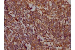 IHC image of ABIN7127482 diluted at 1:100 and staining in paraffin-embedded human lung cancer performed on a Leica BondTM system. (Recombinant FAK 抗体)