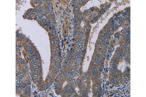 Immunohistochemistry of Human liver cancer using PVRL4 Polyclonal Antibody at dilution of 1:40 (PVRL4 抗体)