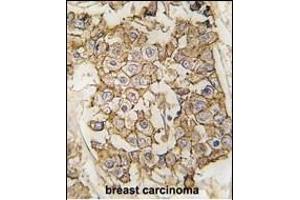 Formalin-fixed and paraffin-embedded human breast carcinoma tissue reacted with HER2/ErbB2 antibody (N-term) (ABIN391945 and ABIN2841744) , which was peroxidase-conjugated to the secondary antibody, followed by DAB staining. (ErbB2/Her2 抗体  (N-Term))