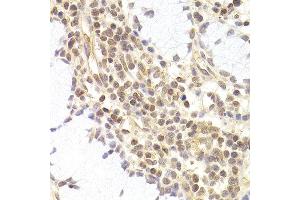 Immunohistochemistry of paraffin-embedded human adenomyosis using PHC1 antibody at dilution of 1:200 (400x lens). (PHC1 抗体)