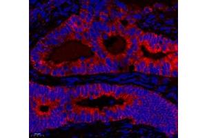 Immunofluorescence of paraffin embedded human colon cancer using NRP2 (ABIN7074826) at dilution of 1: 650 (400x lens) (NRP2 抗体)