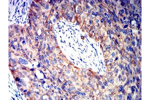 Immunohistochemical analysis of paraffin-embedded cervical cancer tissues using CTNNB1 mouse mAb with DAB staining. (CTNNB1 抗体  (AA 1-100))