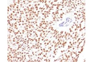 IHC testing of FFPE human bladder carcinoma with FOXA1 antibody. (FOXA1 抗体  (AA 372-472))