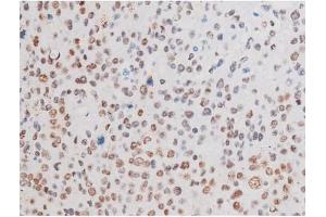 ABIN6267555 at 1/200 staining Human liver cancer tissue sections by IHC-P.