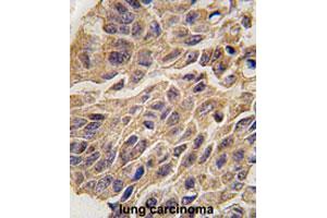 Formalin-fixed and paraffin-embedded human lung carcinomareacted with IDO1 polyclonal antibody , which was peroxidase-conjugated to the secondary antibody, followed by AEC staining.