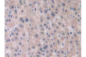 IHC-P analysis of Human Liver cancer Tissue, with DAB staining. (PAFAH2 抗体  (AA 1-392))