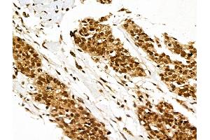 ABIN7094605 and ABIN7098655 at 1/100 staining Human ovarian cancer by IHC-P. (XPO5 抗体  (Internal Region))