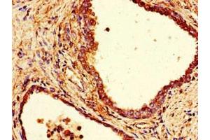 Immunohistochemistry of paraffin-embedded human prostate cancer using ABIN7148014 at dilution of 1:100 (COPE 抗体  (AA 2-308))